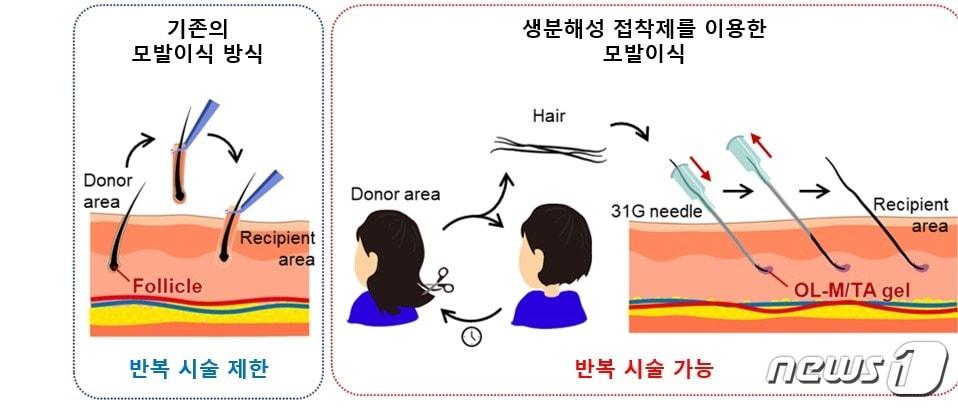 기존 모발이식 방식&#40;왼쪽&#41;과 생분해성 접착제를 이용한 모발이식 방식 개요. &#40;KAIST 제공&#41;