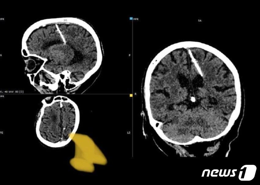 러시아의 80세 여성이 일평생 3㎝ 길이 바늘을 뇌에 꽂고 살아왔다는 사실이 알려지며 충격을 주고 있다.&#40;텔레그램 갈무리&#41;.