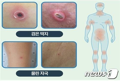 진드기 물린 자국 및 주요 물리는 부위.&#40;남원시 제공&#41;/뉴스1