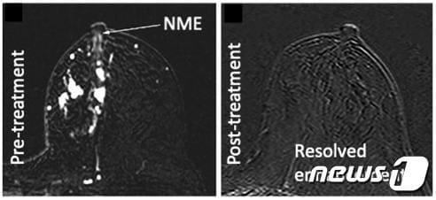 선행항암화학요법 전후 유방 MRI에서의 비종괴성 조영 증강 변화&#40;강남세브란스병원 제공&#41;