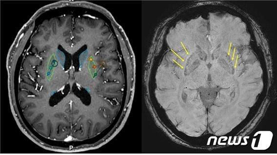 뇌이식 전&#40;왼쪽&#41;과 후 MRI. 이식 후 MRI에서 성공적으로 세포가 이식된 부위&#40;화살표&#41;를 확인할 수 있다. &#40;세브란스병원 제공&#41;