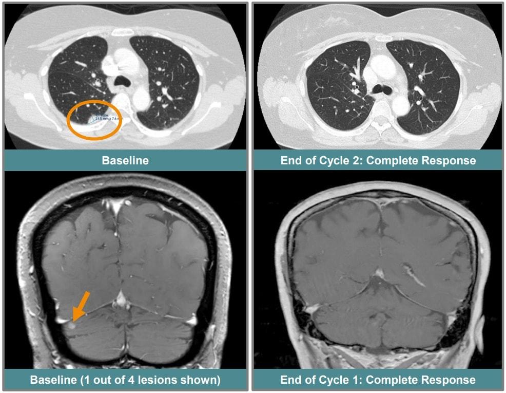 지난해 유럽종양학회&#40;ESMO&#41;에서 발표된 ORCI-114 완전관해 환자 케이스.&#40;ESMO 제공&#41;/뉴스1 ⓒ News1