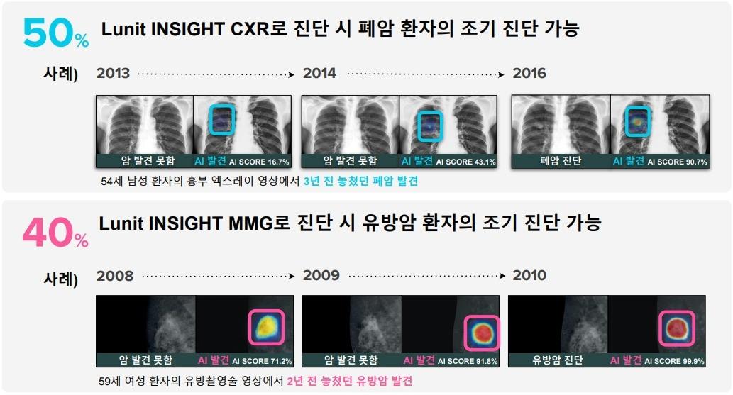 의료 AI 솔루션 &#39;루닛 인사이트&#39;를 활용한 암 조기진단 사례.&#40;루닛 제공&#41;/뉴스1 ⓒ News1