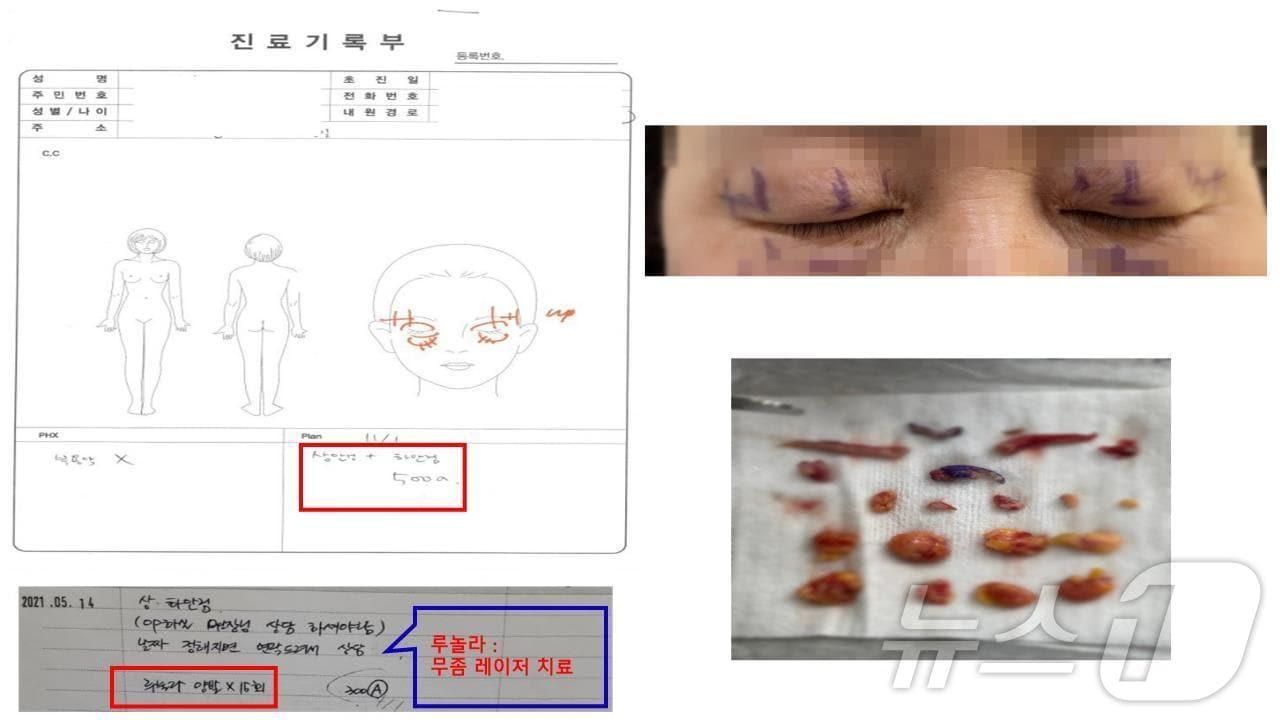 무좀 레이져 치료를 대신해 쌍커풀 수술을 받은 모습.&#40;부산경찰청 제공&#41; 