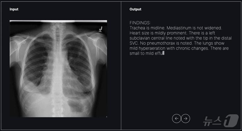 숨빗AI가 개발 중인 영상의학과용 초기 판독문 생성 솔루션 &#39;AI리드-CXR&#39; 활용 모습.&#40;숨빗AI 제공&#41;/뉴스1 ⓒ News1