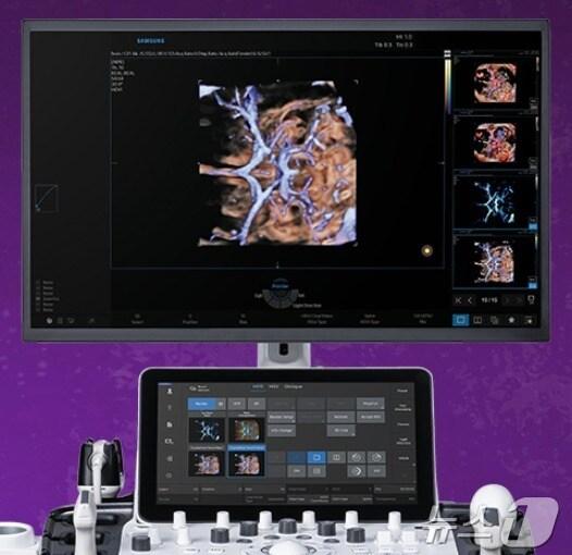삼성메디슨 AI 의료기기 활용 모습.&#40;삼성메디슨 제공&#41;/뉴스1 ⓒ News1