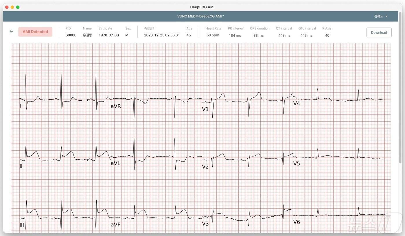 뷰노 메드 딥ECG AMI가 심전도를 분석하고 있다.&#40;뷰노 제공&#41;/뉴스1 ⓒ News1