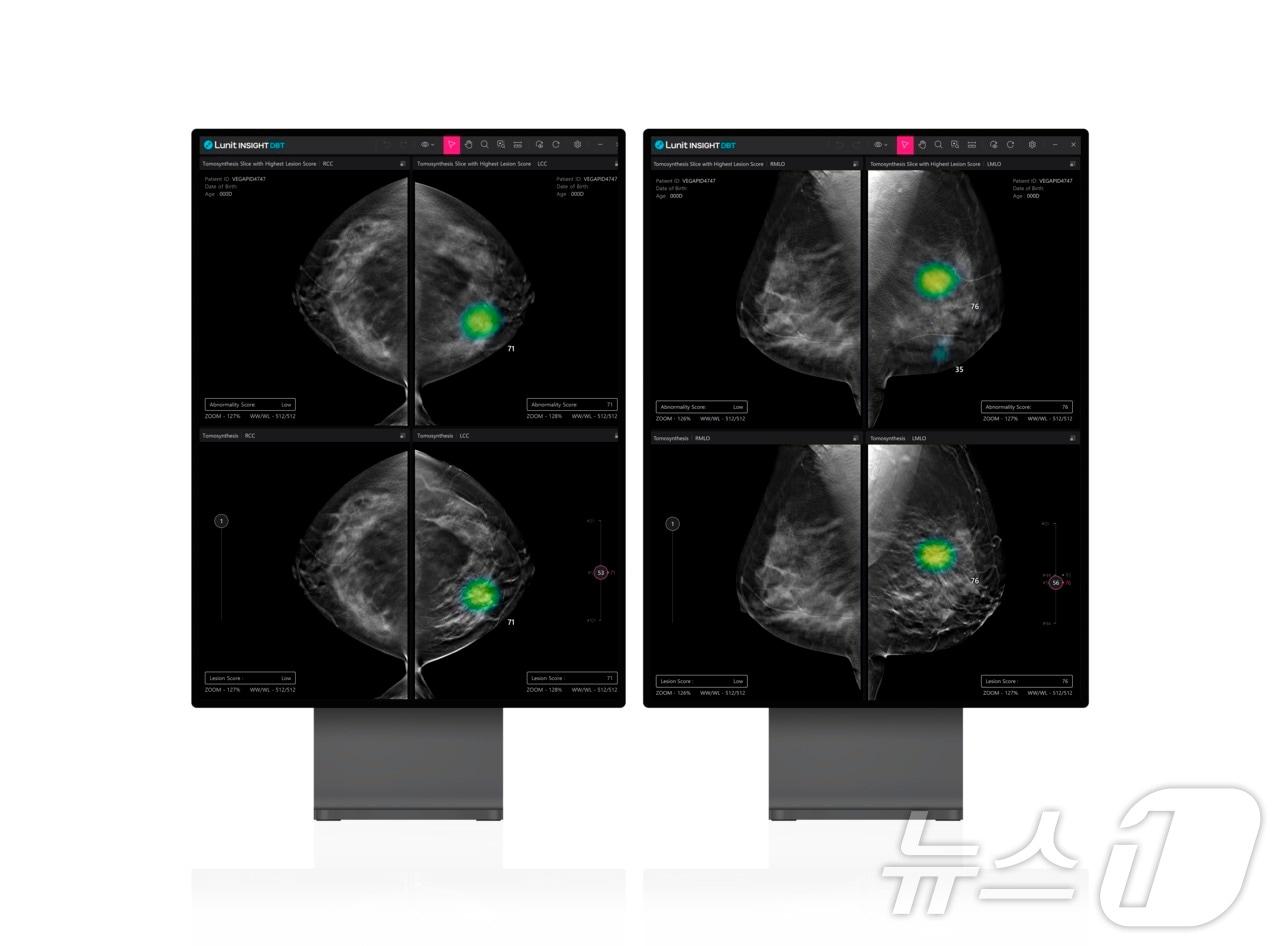 루닛 3차원 유방단층촬영술 AI 의료 영상분석 솔루션 &#39;루닛 인사이트 DBT&#39;.&#40;루닛 제공&#41;/뉴스1 ⓒ News1