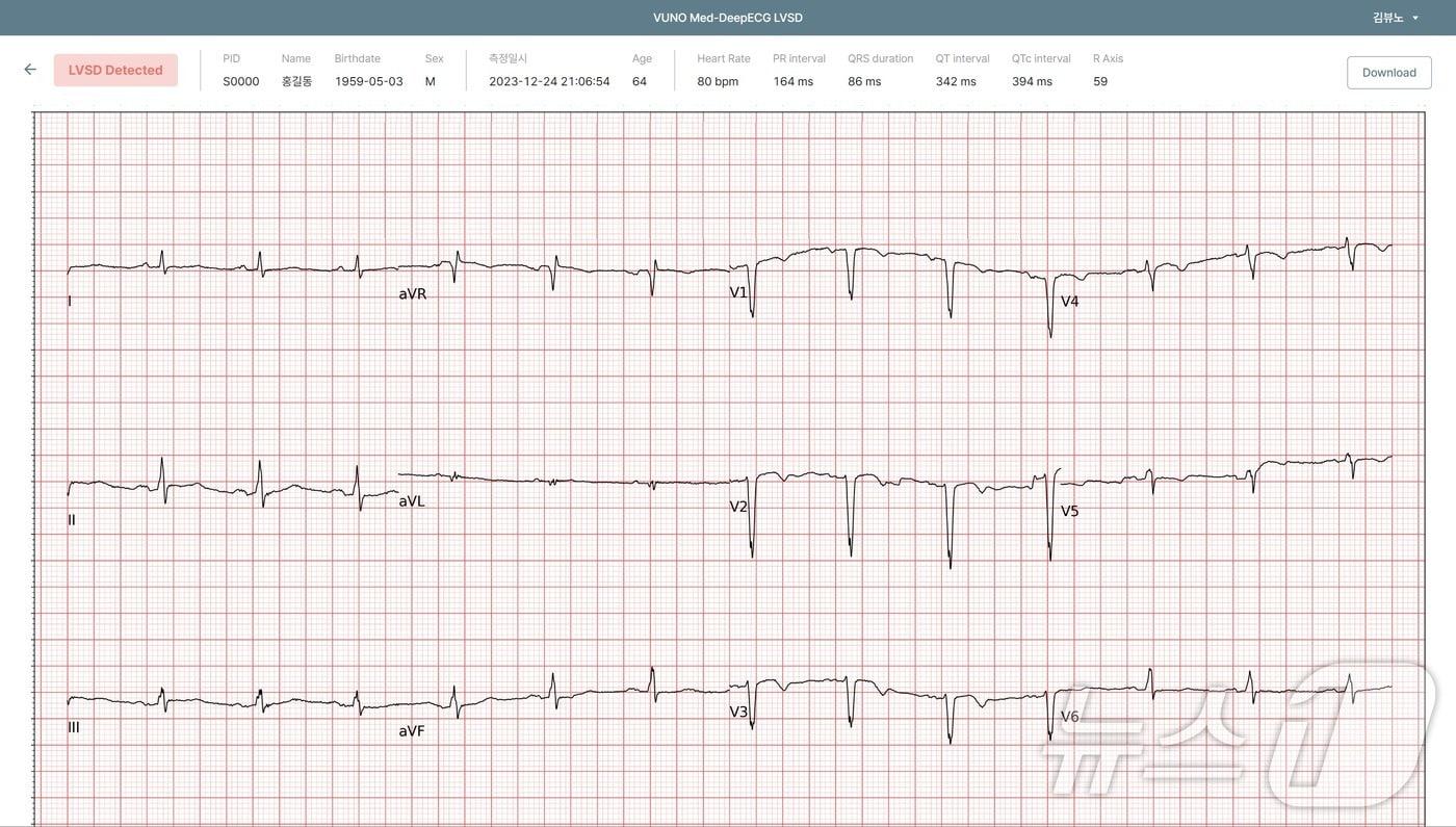 뷰노메드 딥ECG LVSD 운영화면 예시.&#40;뷰노 제공&#41;/뉴스1 ⓒ News1