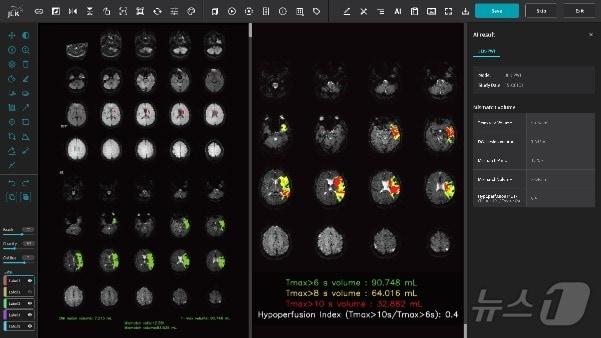 제이엘케이 뇌관류 MR 영상 분석 솔루션 &#39;JLK-PWI&#39; 운영화면 예시.&#40;제이엘케이 제공&#41;/뉴스1 ⓒ News1