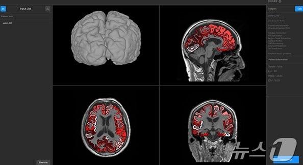 뉴로엑스티 알츠하이머 분석 AI 의료 솔루션 활용 모습.&#40;뉴로엑스티 제공&#41;/뉴스1 ⓒ News1